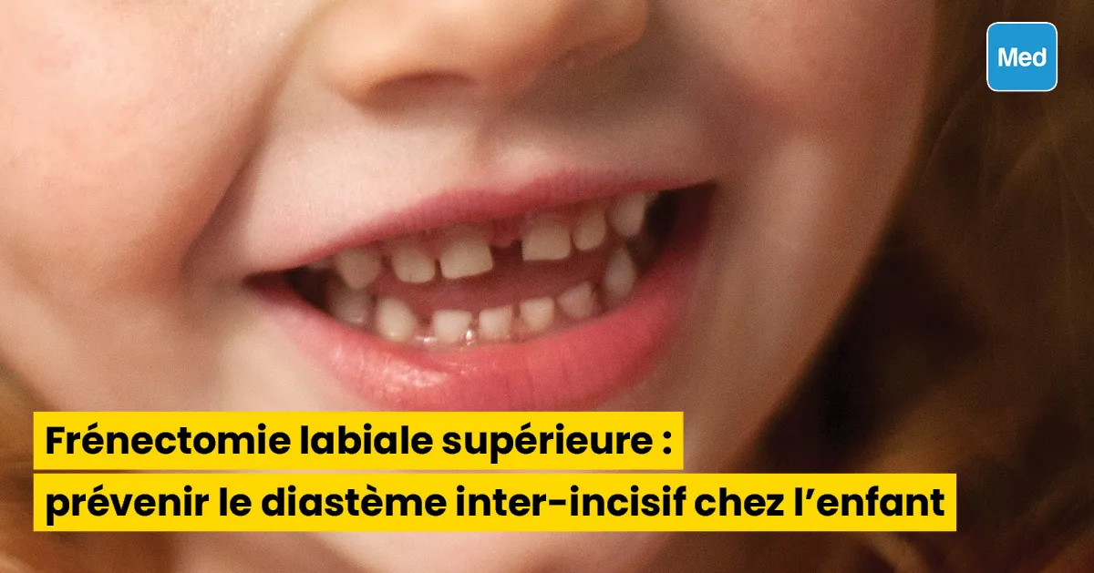 Frénectomie labiale supérieure  prévenir le diastème chez l'enfant